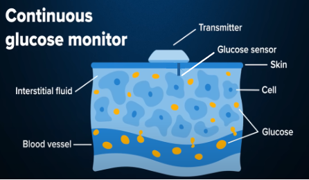 cgm mérés technológi